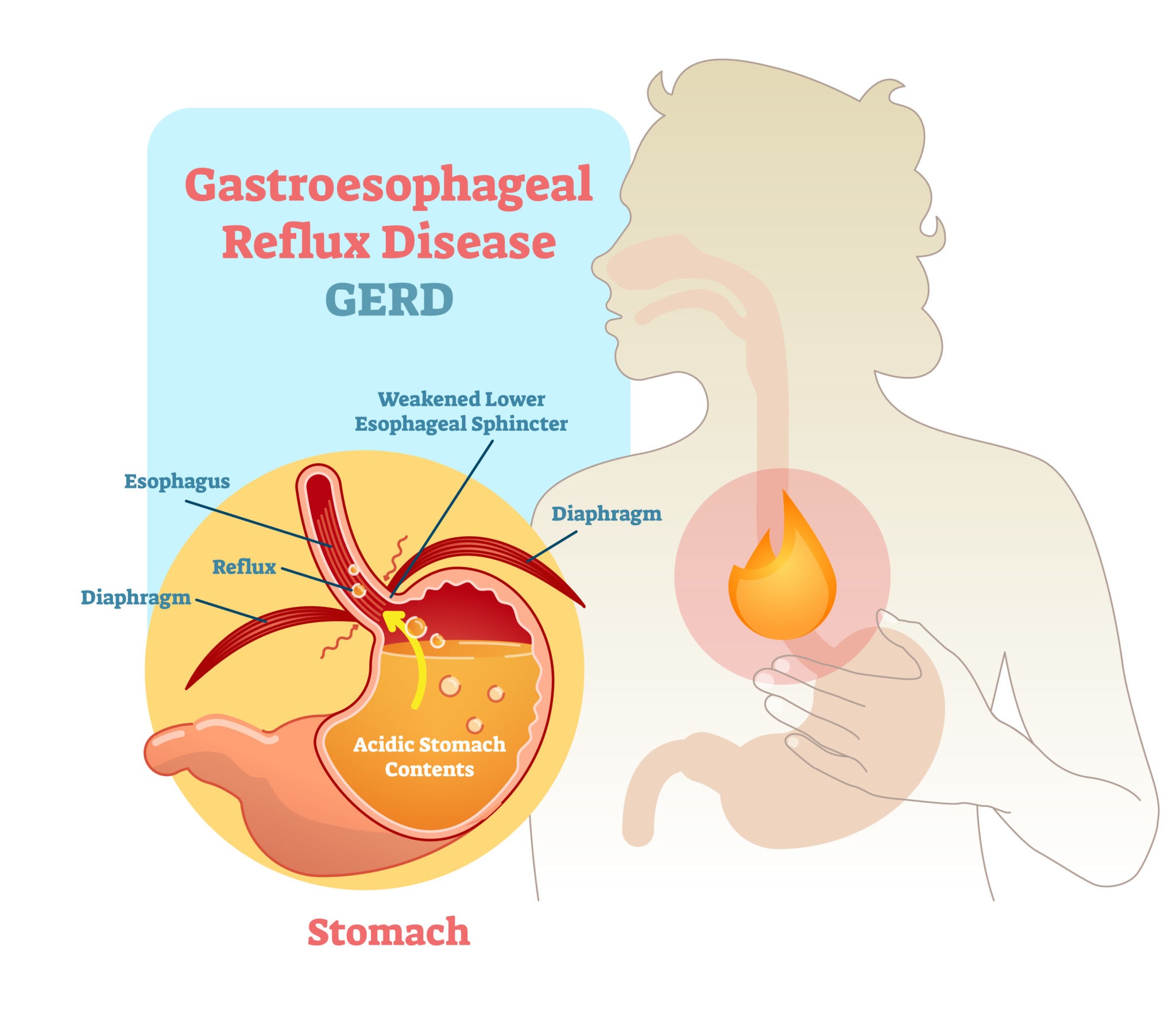 Hình ảnh về gastroesophageal reflux disease diagram