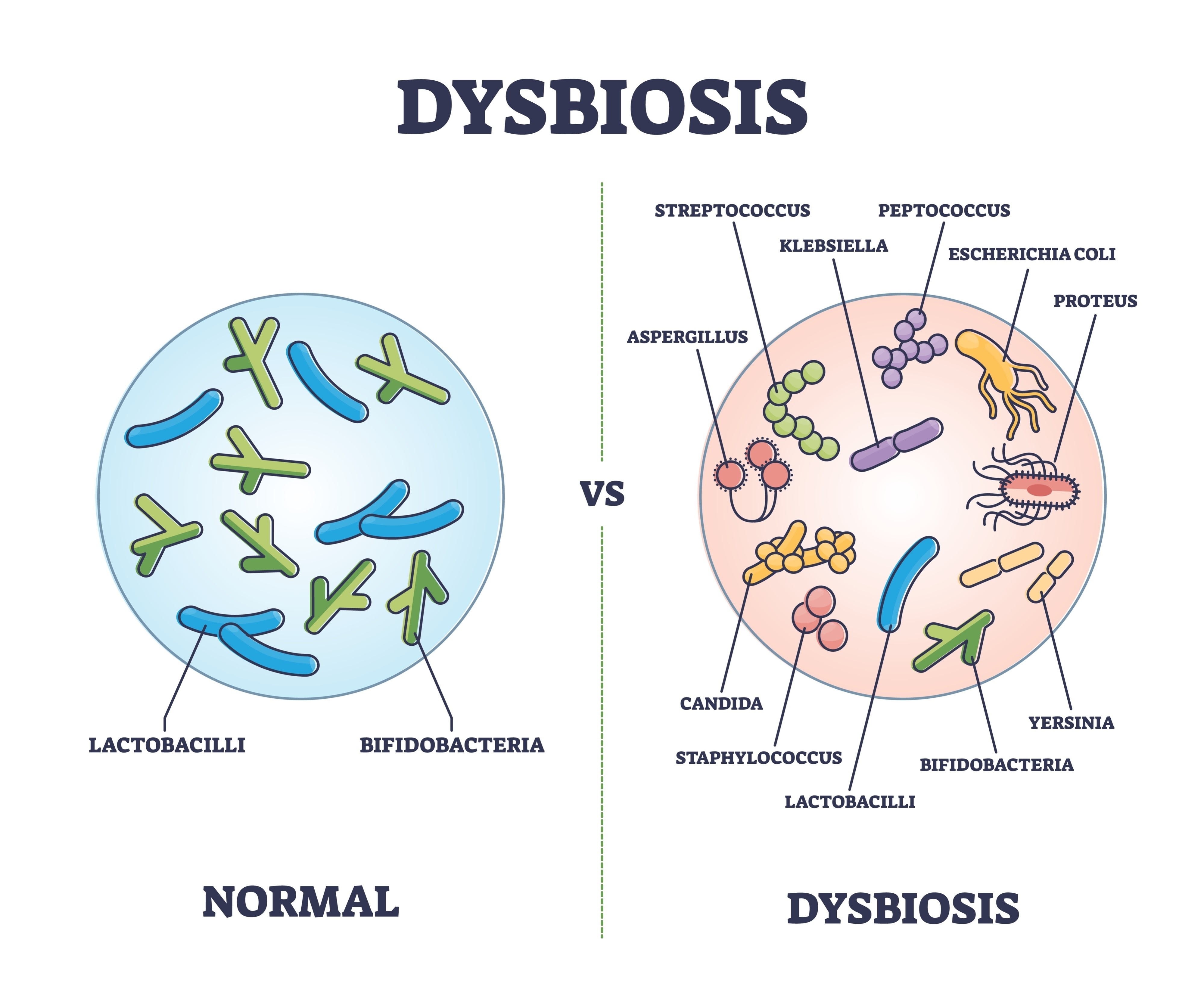 Hình ảnh về gut microbiome balance vs dysbiosis